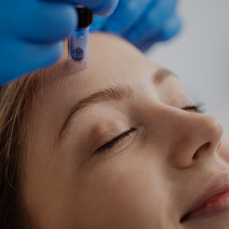 Microneedling